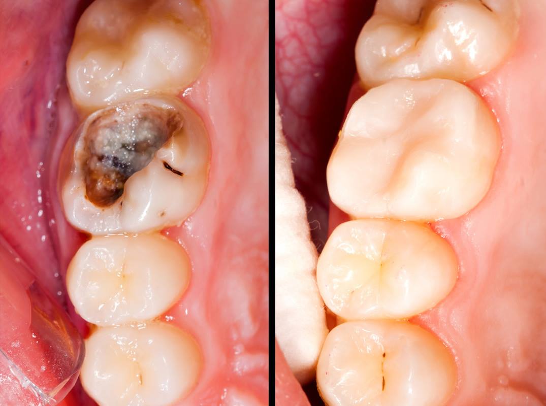 popravka i lečenje zuba